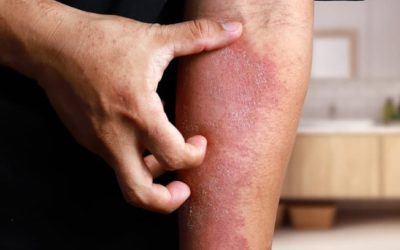Eczema Treatment A Natural Remedy